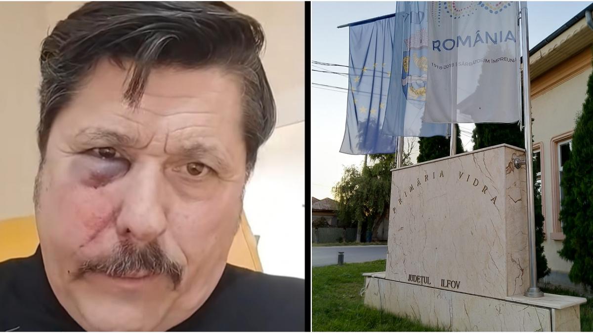 Au atacat cu ura pentru a ma ucide un consilier local aur a fost internat in spital cu o fractura faciala